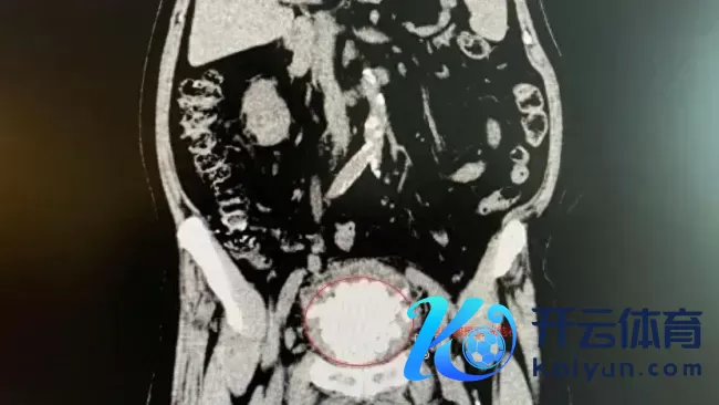 87岁老东说念主膀胱惊现近300颗结石